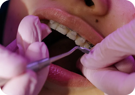 Specialist orthodontist fitting braces during appliance placement
