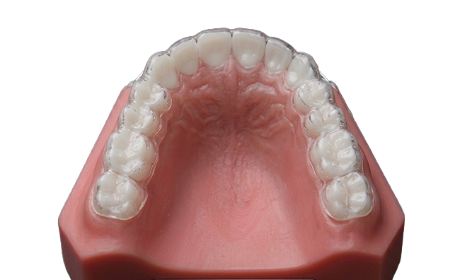 Diagram showing a clear removable Essix retainer on a dental model