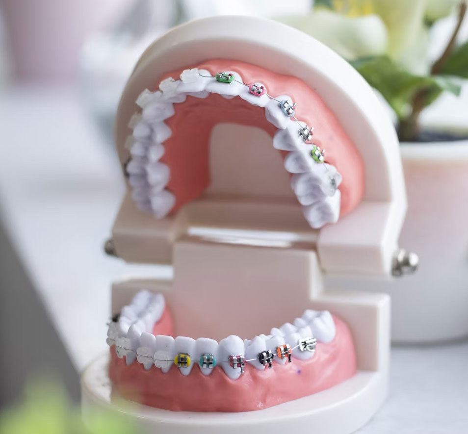 Close-up model of teeth with braces braces, illustrating orthodontic treatment at Dr Carolyn Ng's Hawthorn clinic