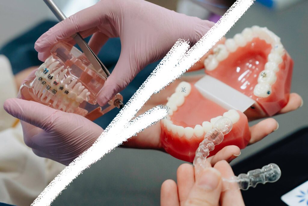 Braces or Aligners