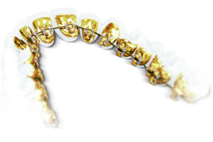 Lingual Braces: Orthodontic Treatment That Stays Hidden