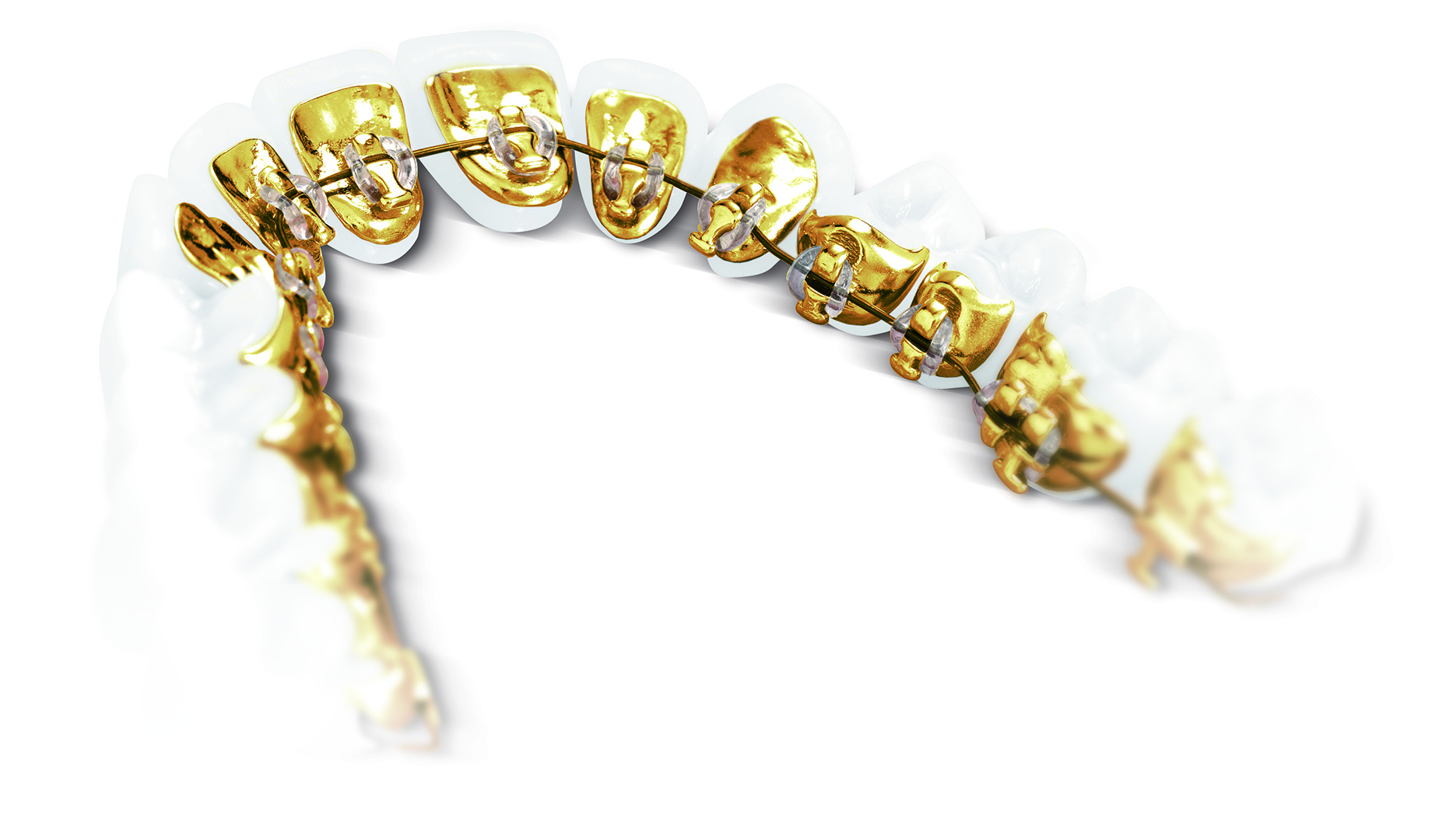 Example how lingaul braces work