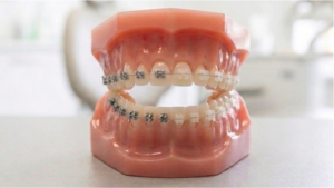 Tooth-Coloured and Clear Ceramic Braces